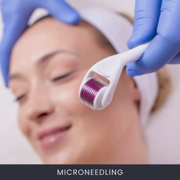 Microneedling Microneedling