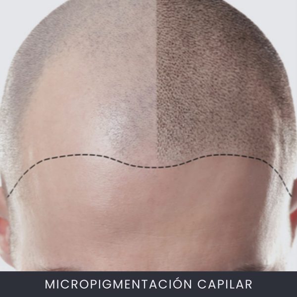 Micropigmentación Capilar Micropigmentación Capilar