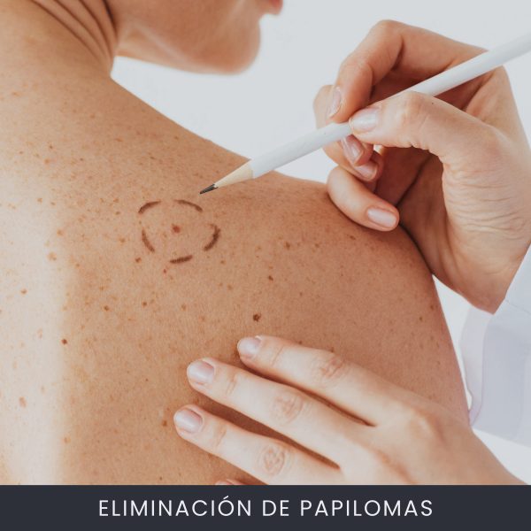 Eliminación De Papilomas Eliminación De Papilomas